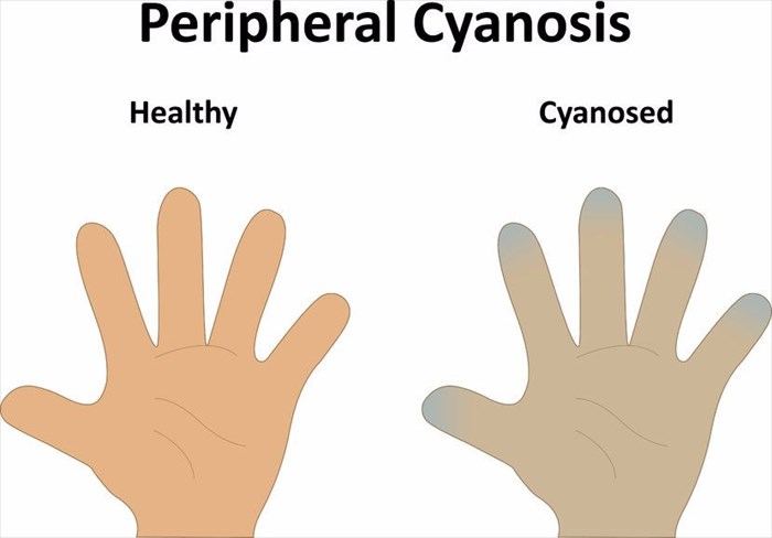 cyanotic skin color