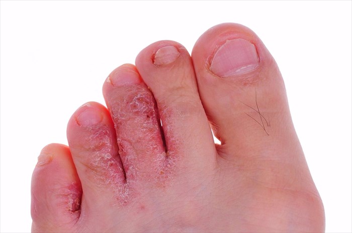 Close-up Of Athlete's Foot (tinea Pedis) Infection Greeting Card