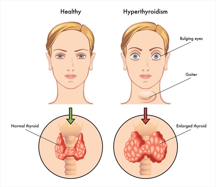 Common types and underlying causes of thyroid disorders