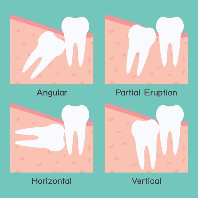 types of impacted wisdom teeth