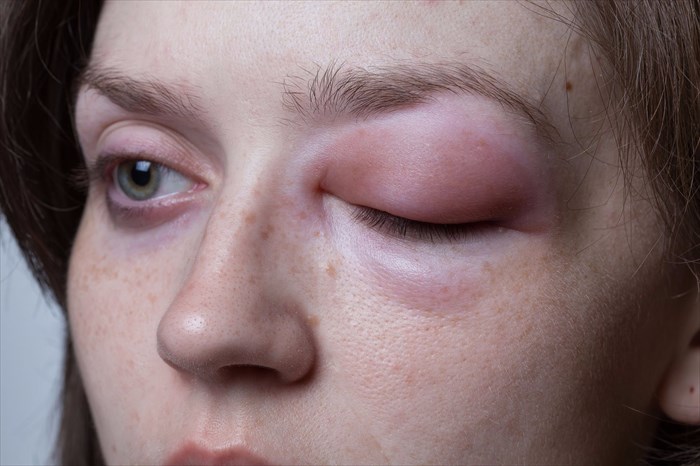 Cholinergic Urticaria Face