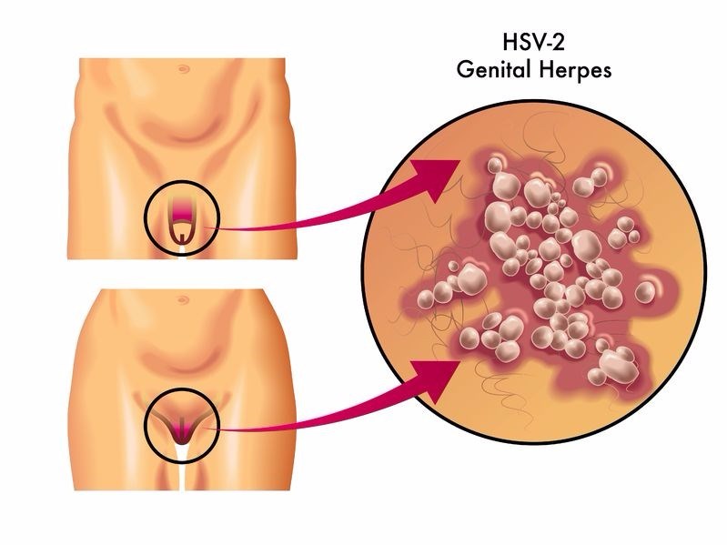 Symptoms herpes genital Genital herpes