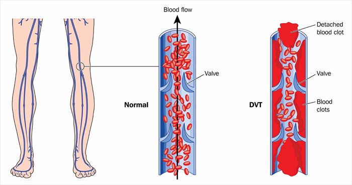 gastrocnemius vein dvt