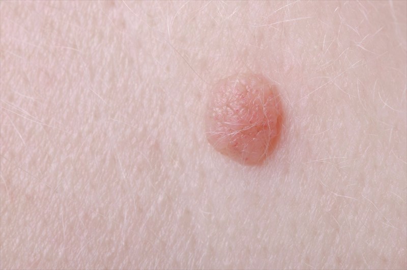 nodule skin