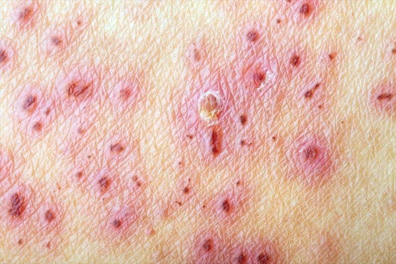 How can I prevent shingles?