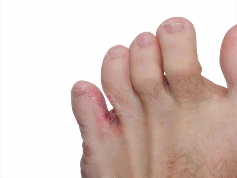 Athlete's foot dry cracked on sale skin