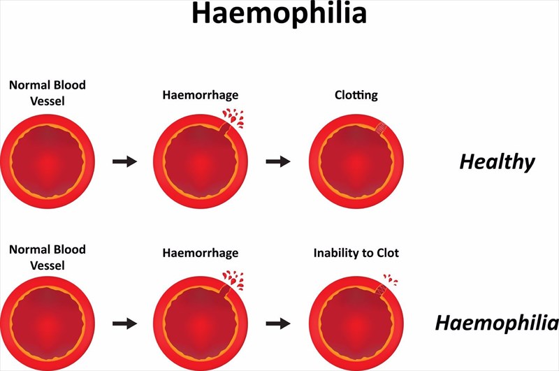 Blood Clots