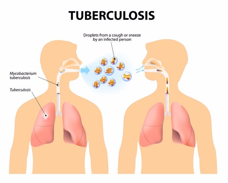 What Are The Signs And Symptoms Of TB 