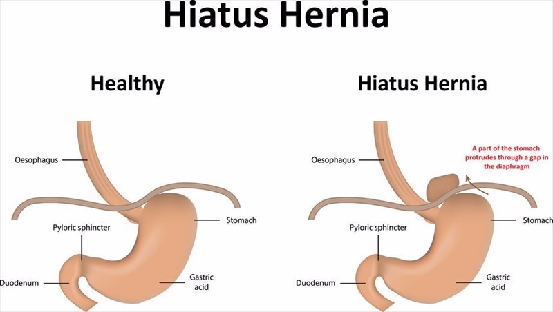 Signs and symptoms of hernia