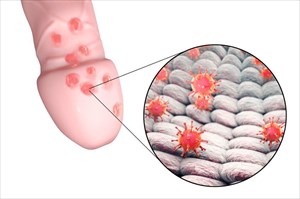 type 2 herpes in men