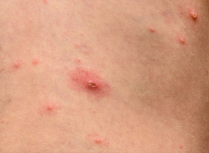 5-ways-to-recognize-chickenpox-wikihow