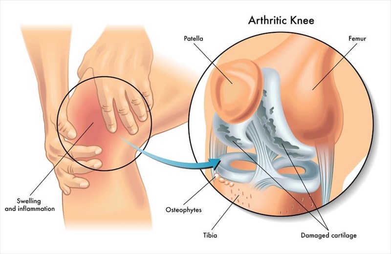 types-of-arthritis