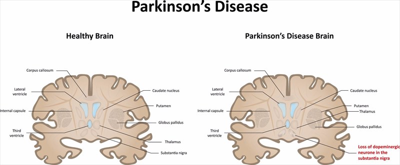 how-does-parkinson-s-disease-affect-the-body