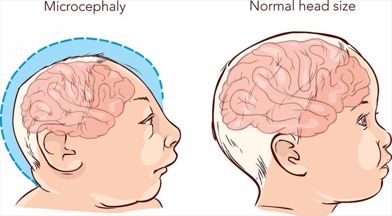 what-types-of-complications-are-associated-with-the-zika-virus