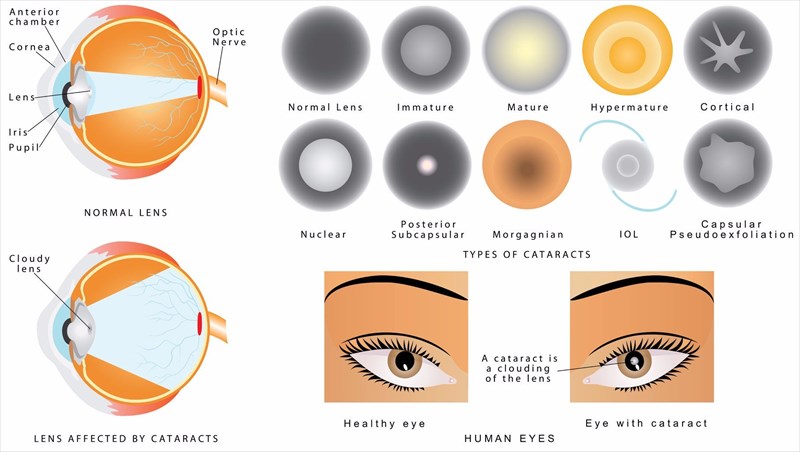 cataracts types