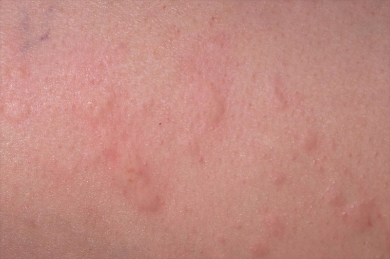 urticaria face rash