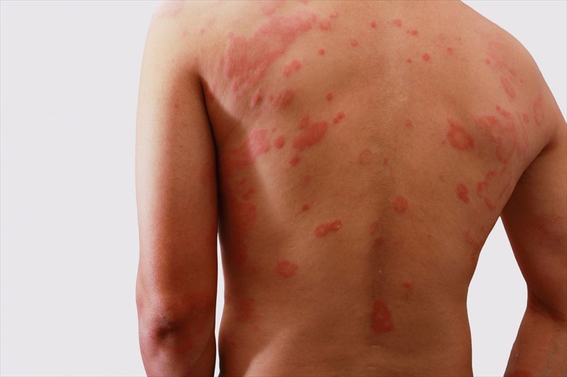 What other conditions may mimic hives?