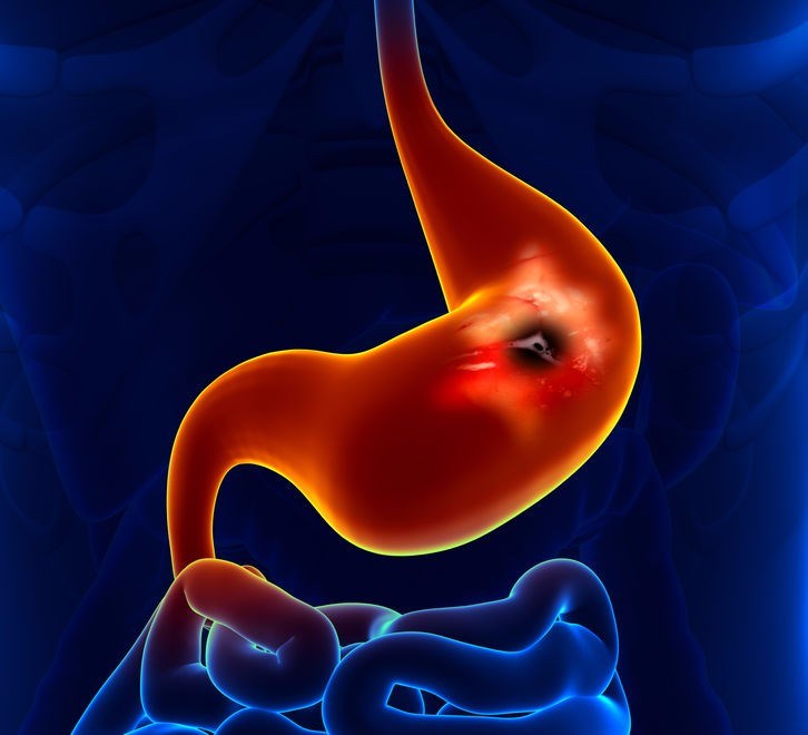 modified-johnson-classification-for-gastric-ulcers-type-grepmed