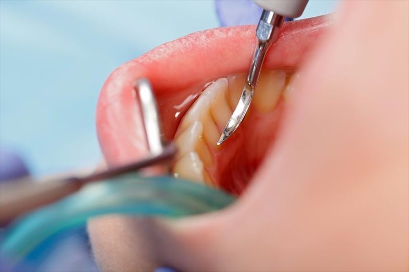 How is gingivitis diagnosed and treated?
