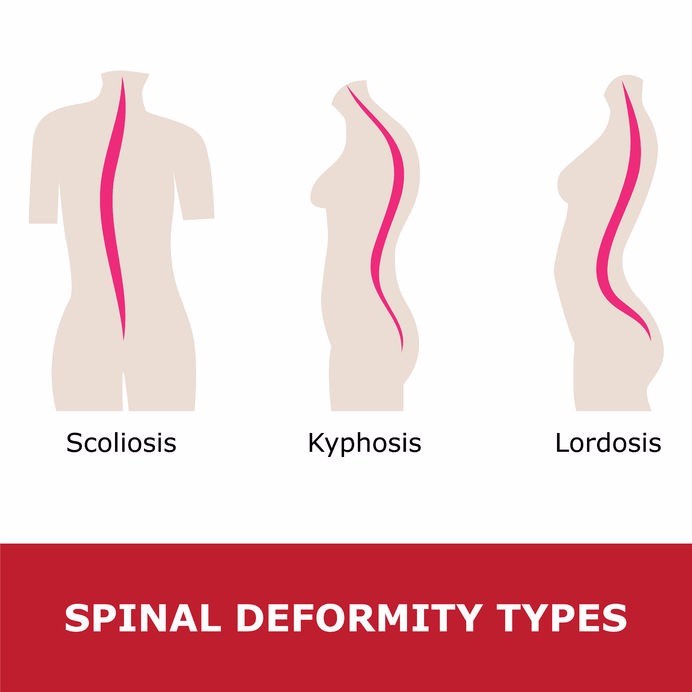 scoliosis spine curvature