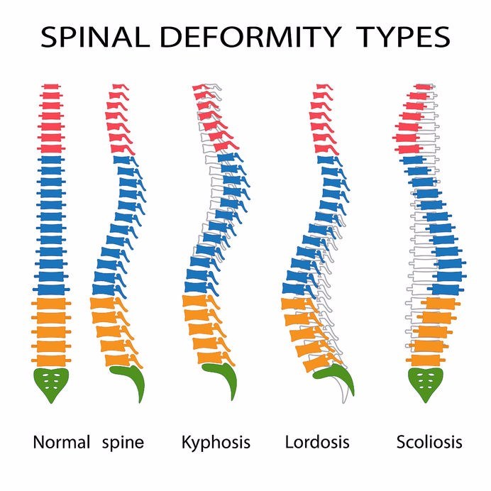 showing dorso lumbar scoliosis with anterior breaking at D12, L1,2