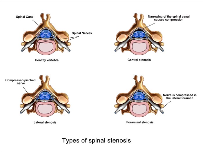 What Is Spinal Stenosis?