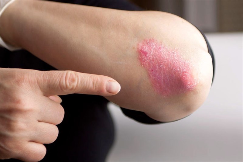 eczema on elbows