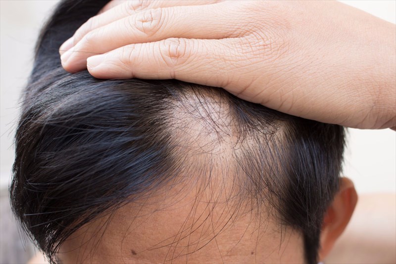 Non store scarring alopecia