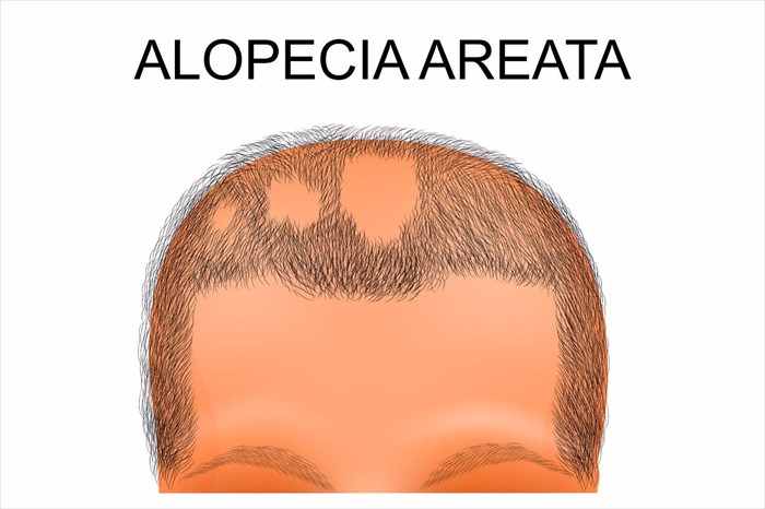 Understanding The Different Types Of Alopecia