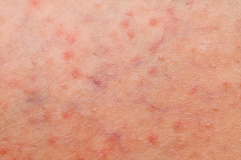 Bacterial Folliculitis Groin