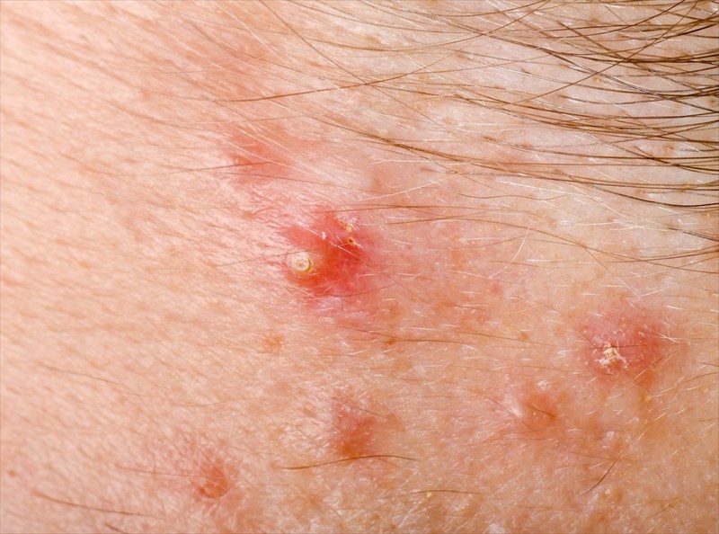 What Are The Signs And Symptoms Of Folliculitis 