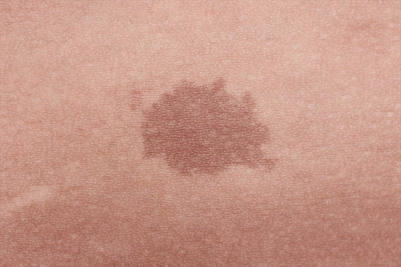 brown birthmarks