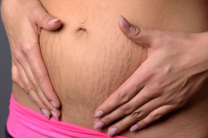 What are stretch marks?