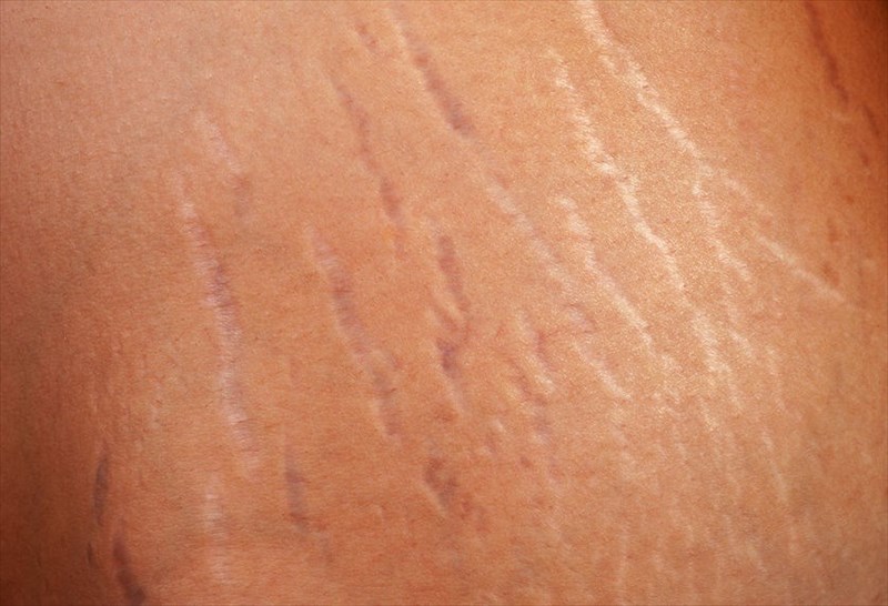 Stretch marks/micro fissures between two surface breaking portions