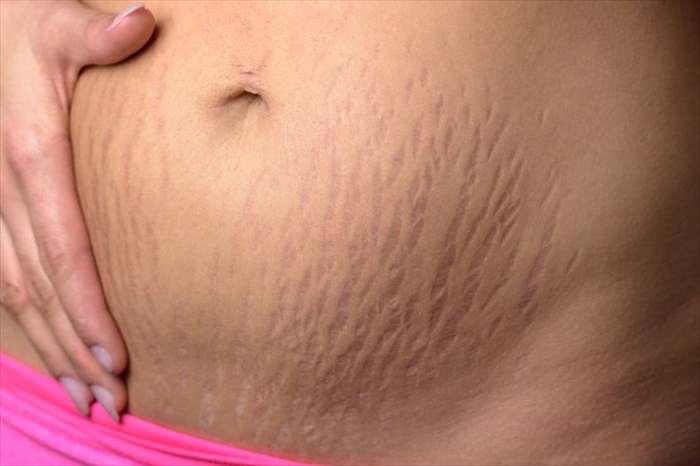 Stretch marks/micro fissures between two surface breaking portions of