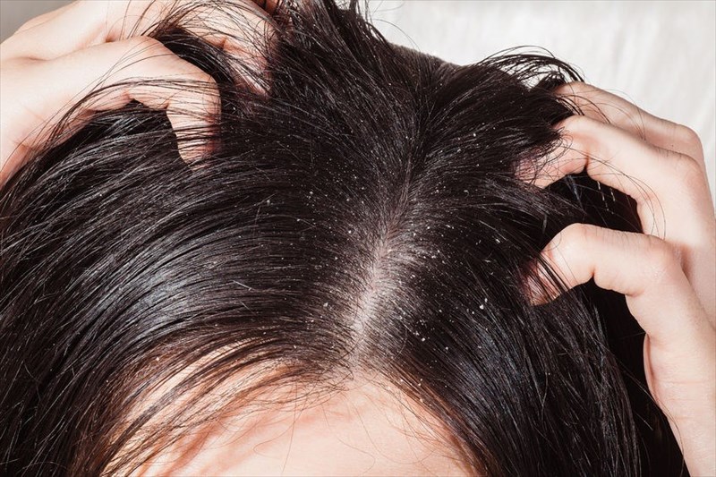seborrheic dermatitis scalp african american hair