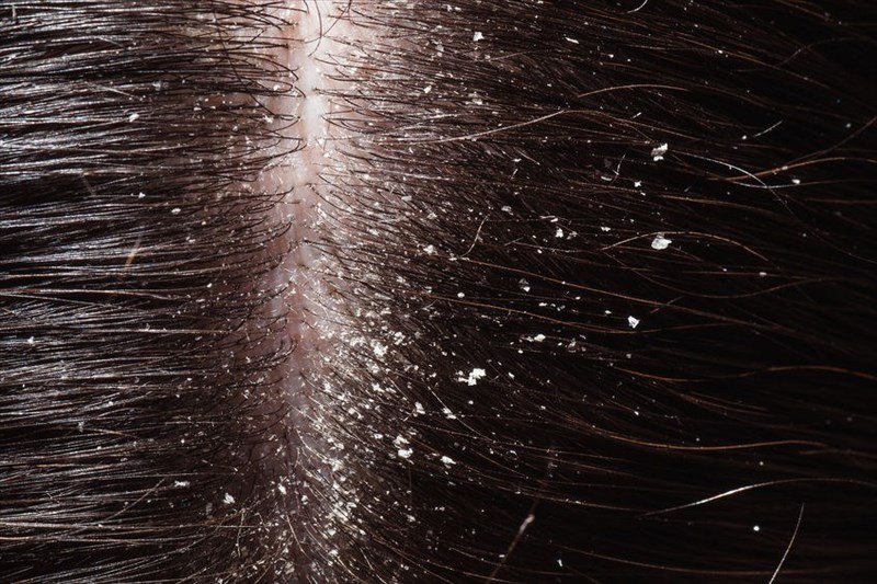 Signs And Symptoms Of Dandruff 