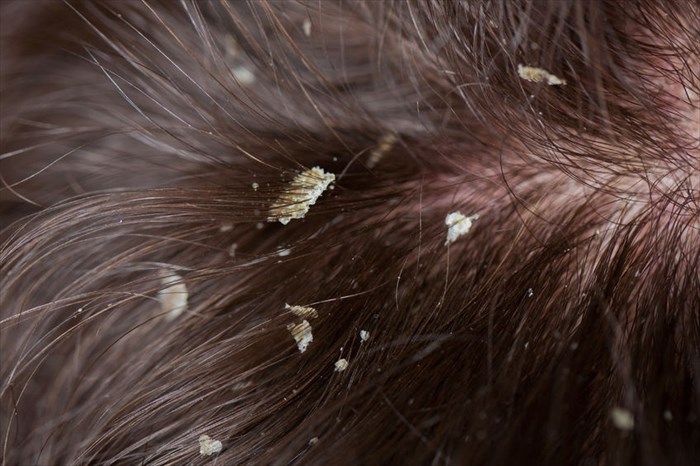 dandruff flakes in hair