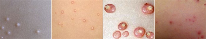 Molluscum Contagiosum - The virus, it's symptoms and treatment