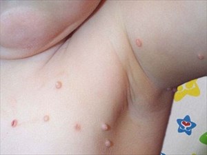 Molluscum Contagiosum: Stages, Treatment, Kids Vs. Adults