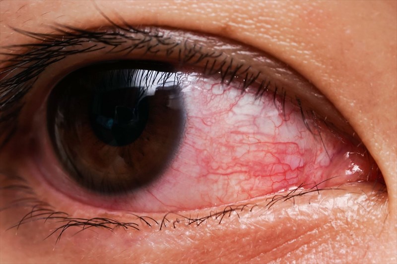 Pink Eye Conjunctivitis Causes Treatment Prevention 59 Off 