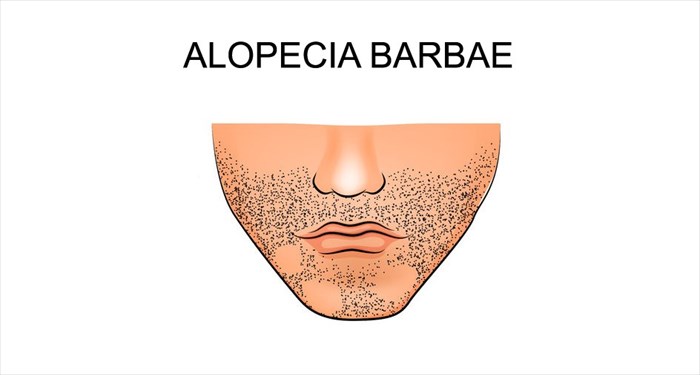 Understanding The Different Types Of Alopecia