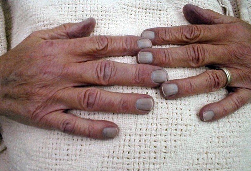 Normal Fingernail Color