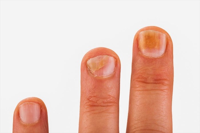 fingernails-and-health-signs-10-signs-that-could-woc-print-lupon-gov-ph