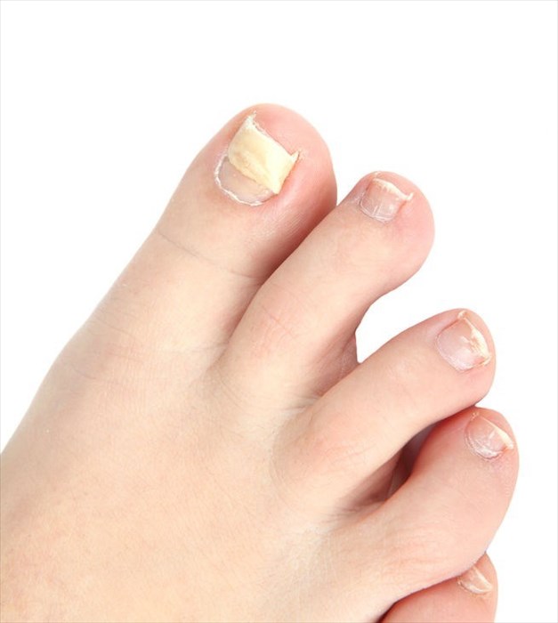 Yellow and thickened toes' nails with lymphedema