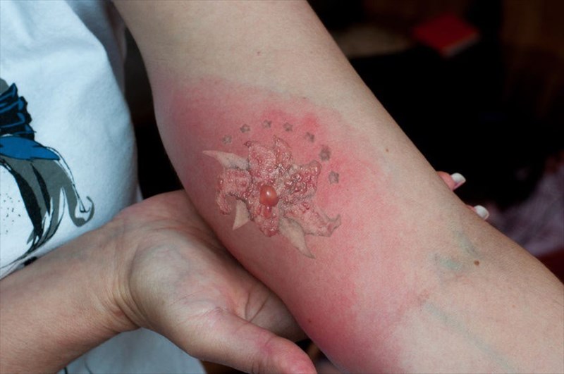 Inflammation occurring in the red ink portion of a tattoo