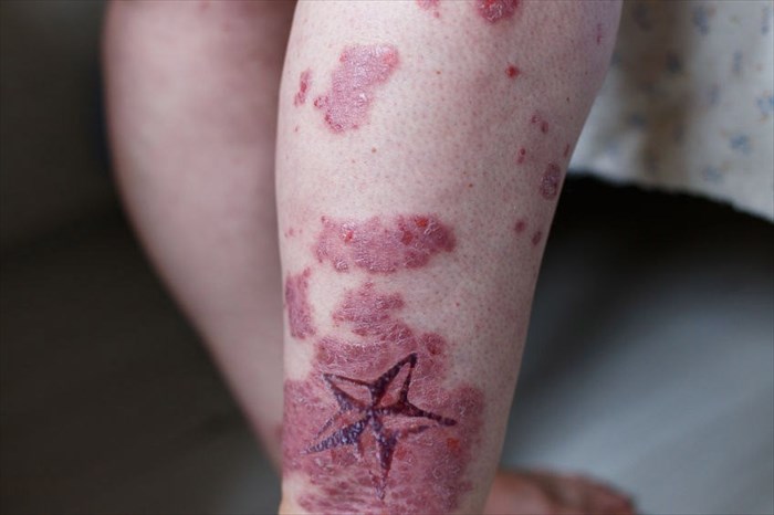 Signs And Symptoms Of Tattoo Infection And What To Do About It