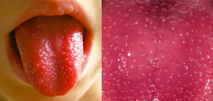 Strawberry Tongue The Symptom And Its Various Causes Explored