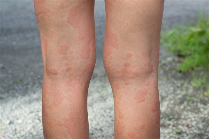 strep throat rash on legs