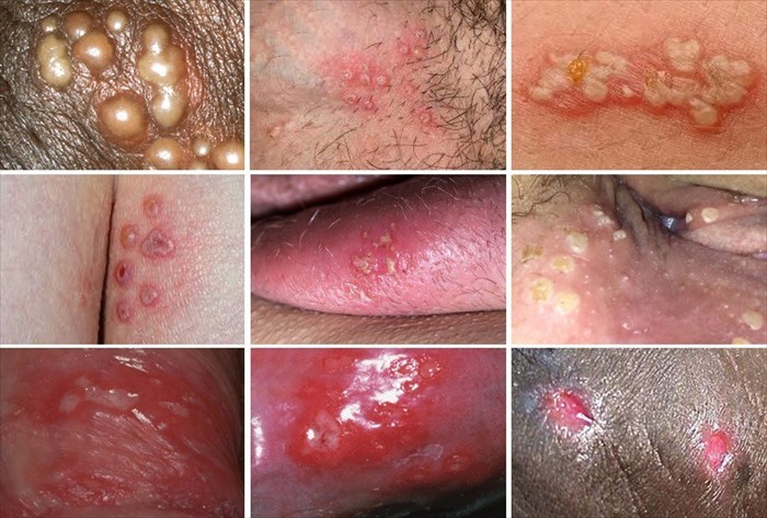 genital herpes men first signs